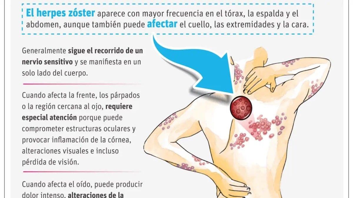 Herpes zóster: un virus latente que puede reactivarse tras décadas
