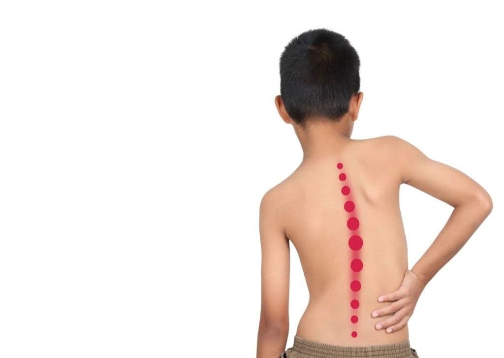 Detección temprana de escoliosis en adolescentes: recomendaciones y advertencias