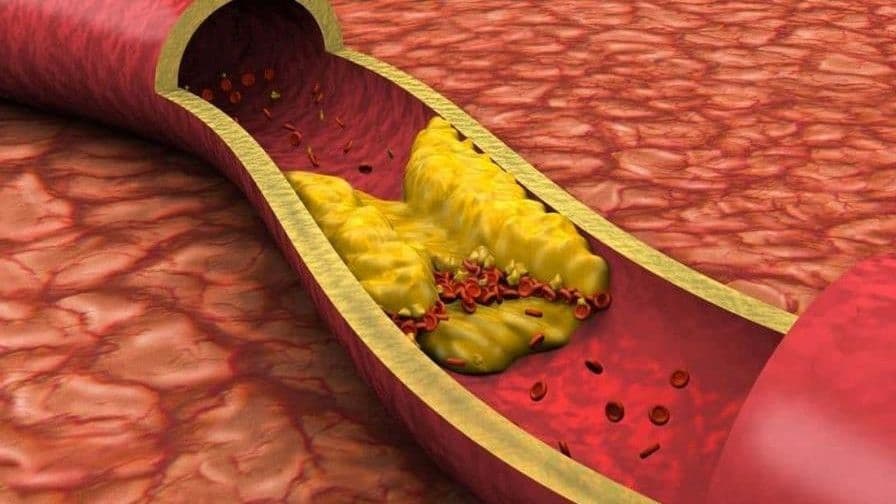 La aterosclerosis: un riesgo latente para infartos y accidentes cerebrovasculares
