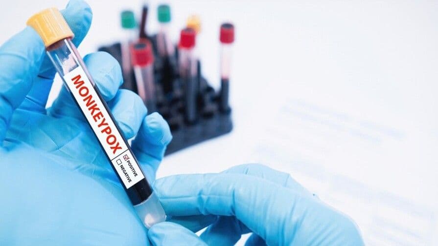 Detectan casos de viruela símica en San Cristóbal