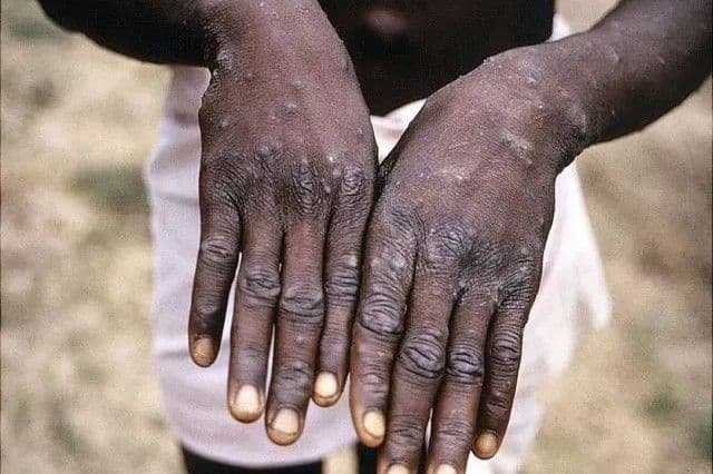 Salud Pública confirma casos de viruela símica en San Cristóbal